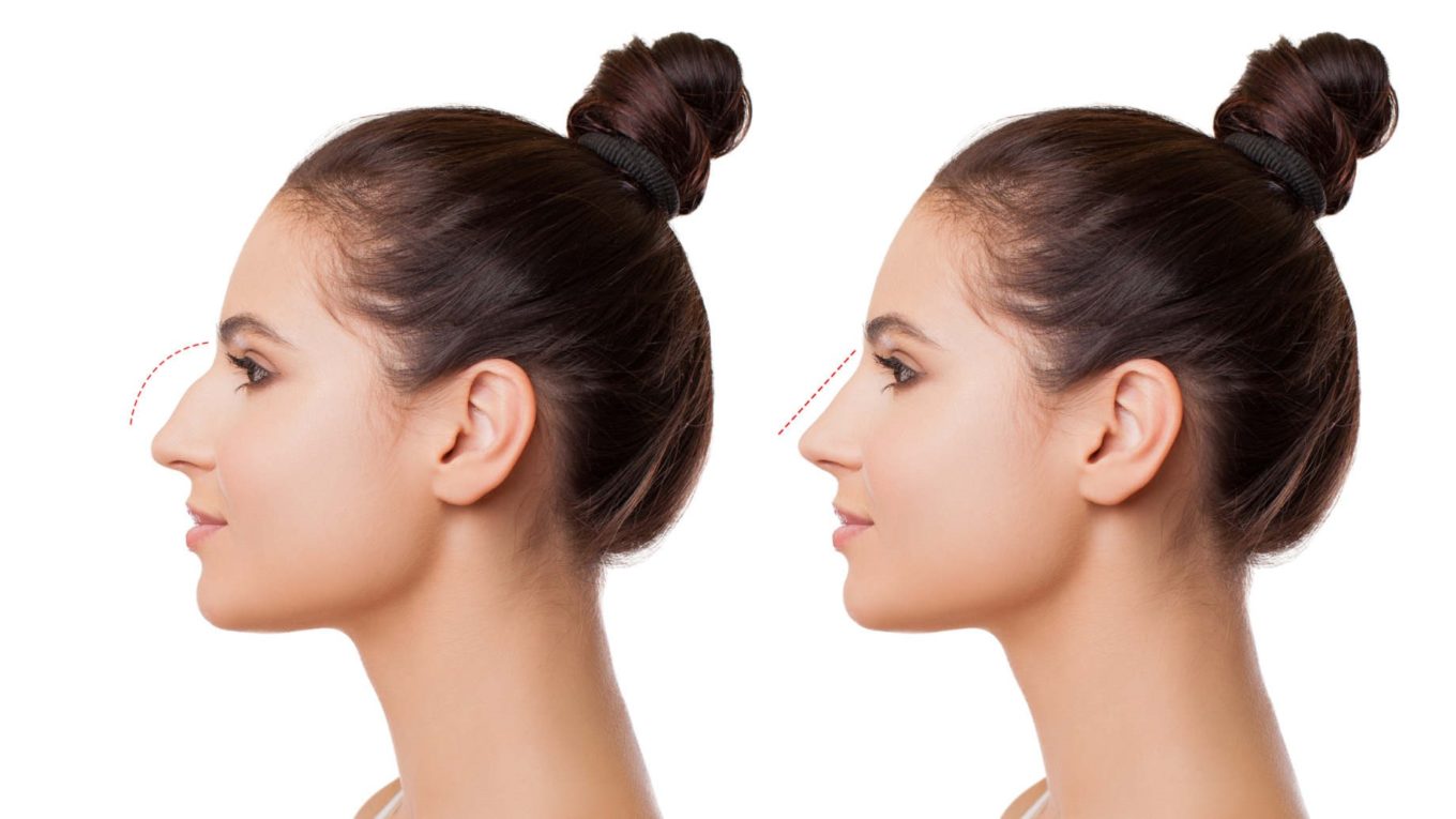 rhinoplastie